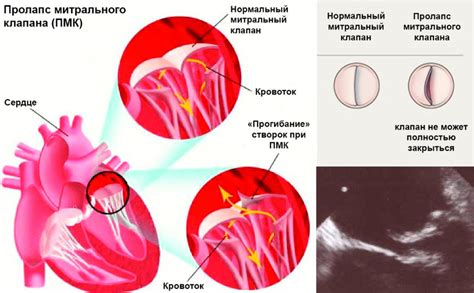 Диагностика и обследование пролапса митрального клапана