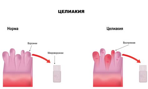 Диагностика и способы лечения низкого индекса перфузии: современные методы и техники