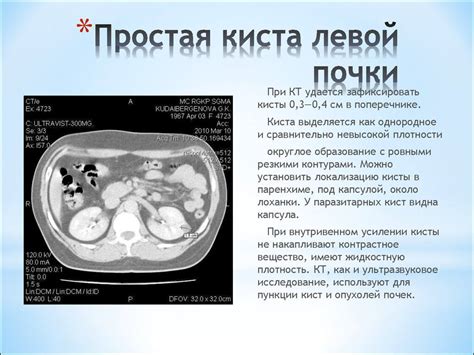 Диагностика кисты левой почки