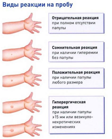 Диагностика манту без папулы