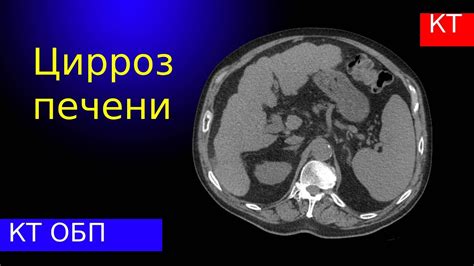 Диагностика мелкозернистой текстуры печени