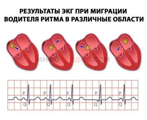 Диагностика миграции водителя ритма