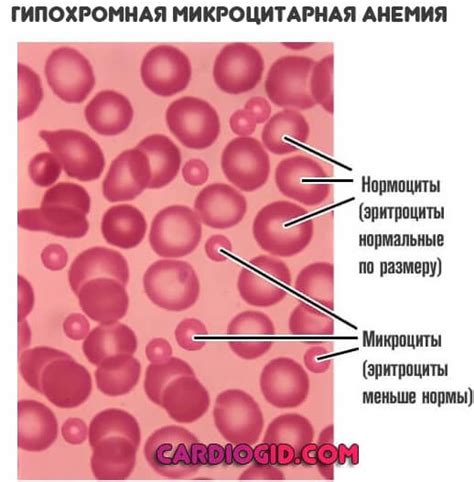 Диагностика микроцитоза у женщин