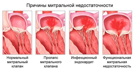 Диагностика митральной регургитации 1 степени у подростков