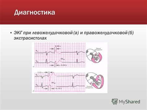 Диагностика наджелудочковой экстрасистолии бигеминии