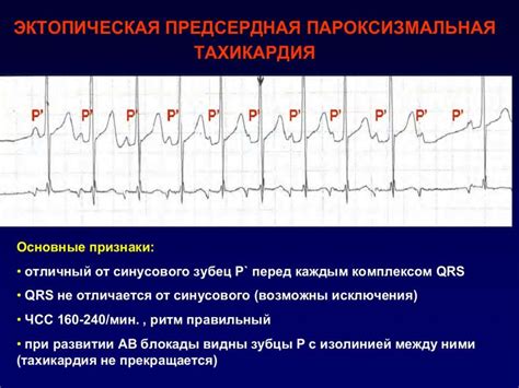 Диагностика нарушений ритма сердца