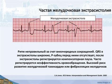 Диагностика нарушения межжелудочковой проводимости