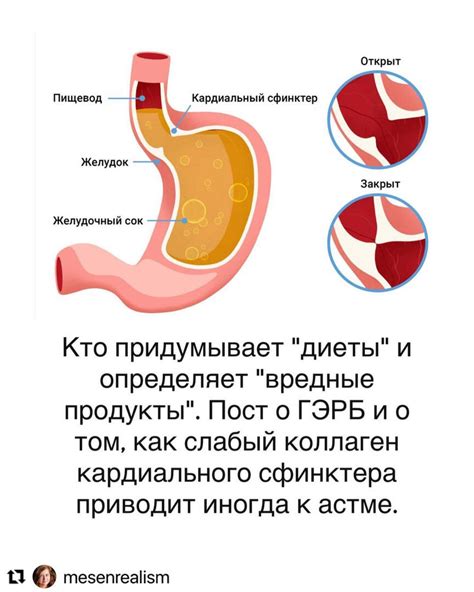 Диагностика недостаточности кардиального сфинктера желудка