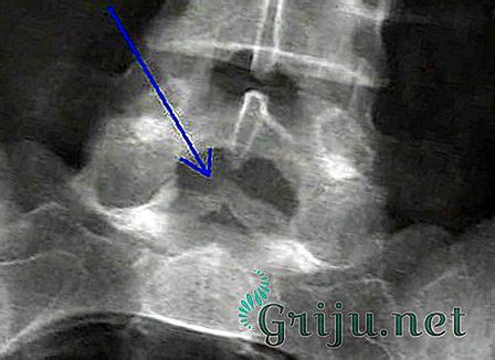 Диагностика незаращения дужек S1 позвонка