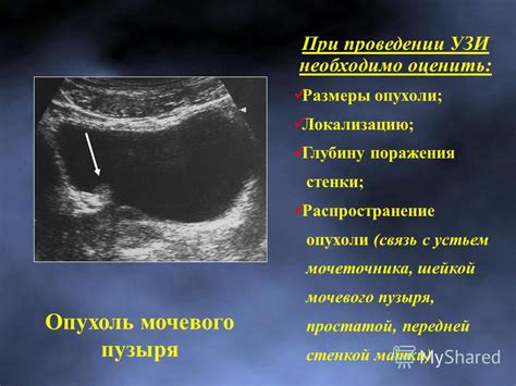 Диагностика незначительного пролапса передней стенки мочевого пузыря