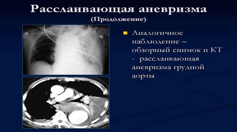 Диагностика неоперабельной аневризмы аорты