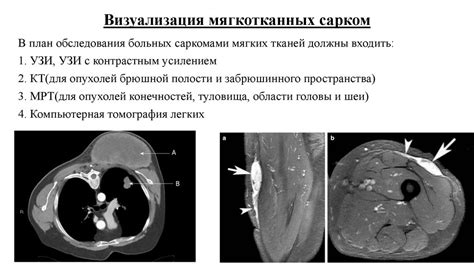 Диагностика неоперабельной саркомы мягких тканей