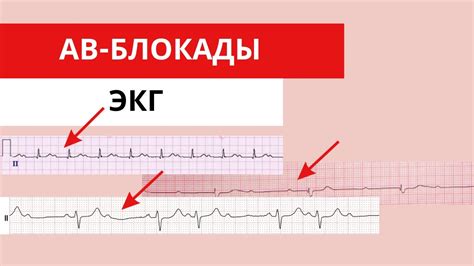 Диагностика неполной ав блокады