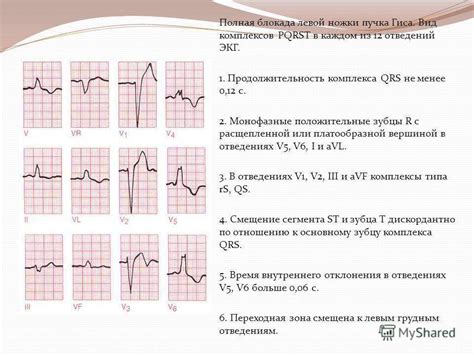 Диагностика неполной блокады правой ножки пучка Гиса