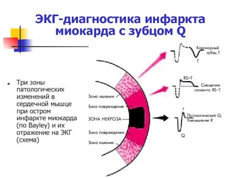 Диагностика неспецифических изменений миокарда