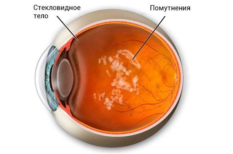 Диагностика нитчатой деструкции стекловидного тела