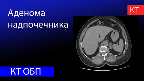 Диагностика новообразования надпочечника