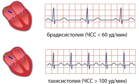 Диагностика нормосистолии с нерегулярным синусовым ритмом