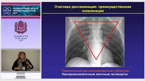 Диагностика остеолитического очага