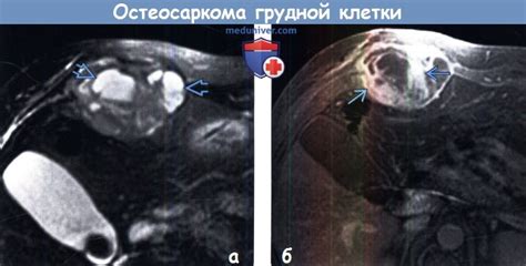 Диагностика остеосаркомы