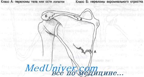 Диагностика ости лопатки