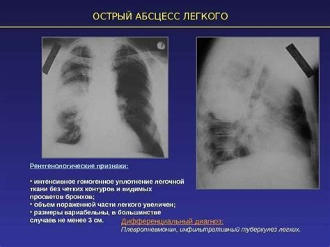 Диагностика отслоения легкого