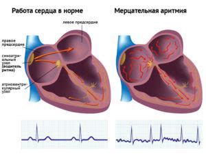 Диагностика отсутствия линии сердца