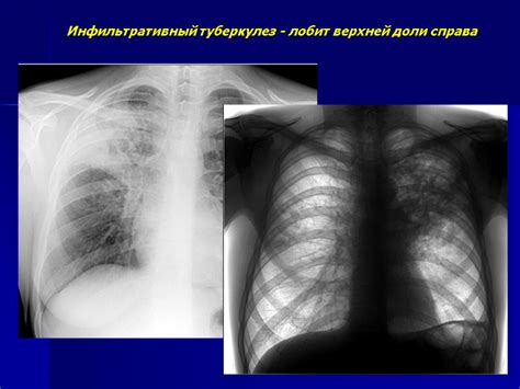 Диагностика очагового туберкулеза верхней доли левого легкого