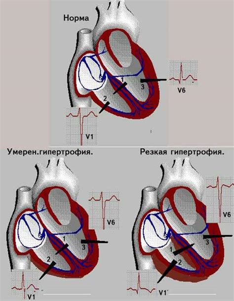 Диагностика перегрузки правого желудочка сердца