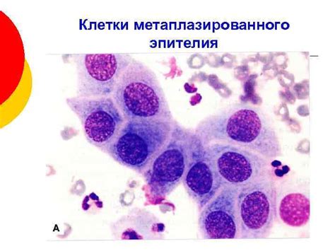 Диагностика плоскоклеточного метаплазированного эпителия