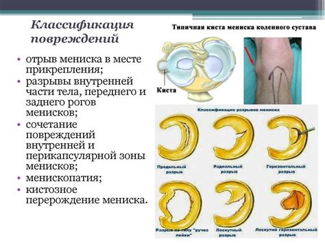 Диагностика повреждения мениска