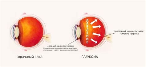 Диагностика повышенного глазного давления