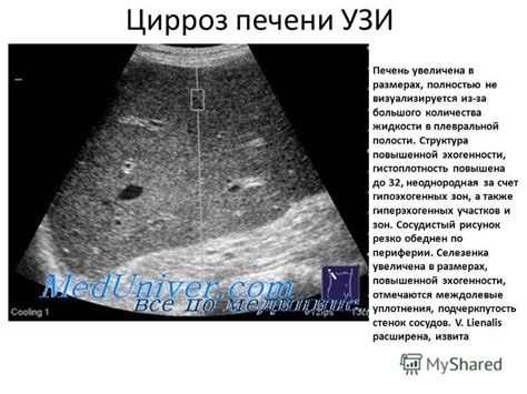 Диагностика повышенной эхогенности печени