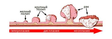 Диагностика полипов прямой кишки