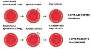 Диагностика пониженной свертываемости крови