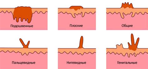 Диагностика потемнения папилломы