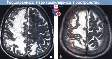 Диагностика расширенных периваскулярных пространств