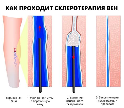 Диагностика ретикулярного внутрикожного варикоза