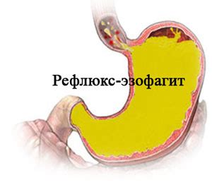 Диагностика рефлюкс эзофагита 1 степени