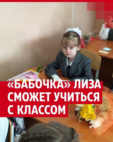 Диагностика синдрома бабочки