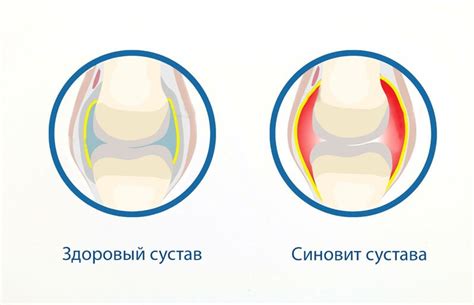 Диагностика синовита