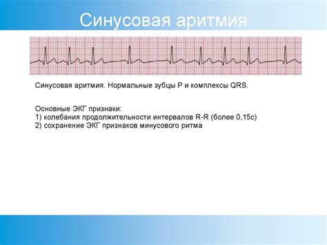 Диагностика синусной аритмии