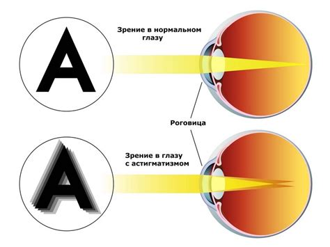 Диагностика сложного миопического астигматизма