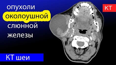 Диагностика смешанной опухоли околоушной слюнной железы