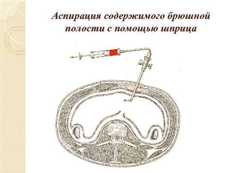 Диагностика содержимого хориальной полости с редкой взвесью