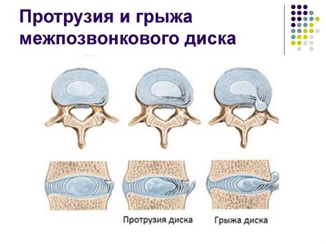 Диагностика субартикулярной протрузии диска