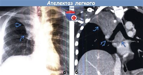 Диагностика субсегментарного ателектаза правого легкого
