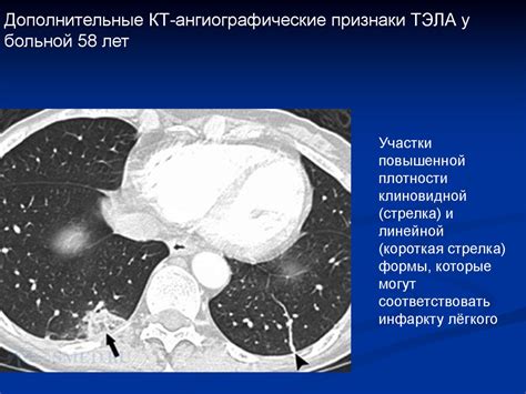 Диагностика тромбоэмболии легочной артерии