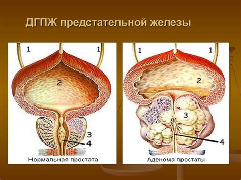 Диагностика увеличения объема предстательной железы