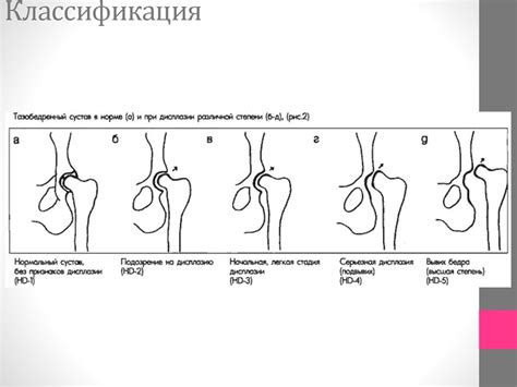 Диагностика удара от бедра